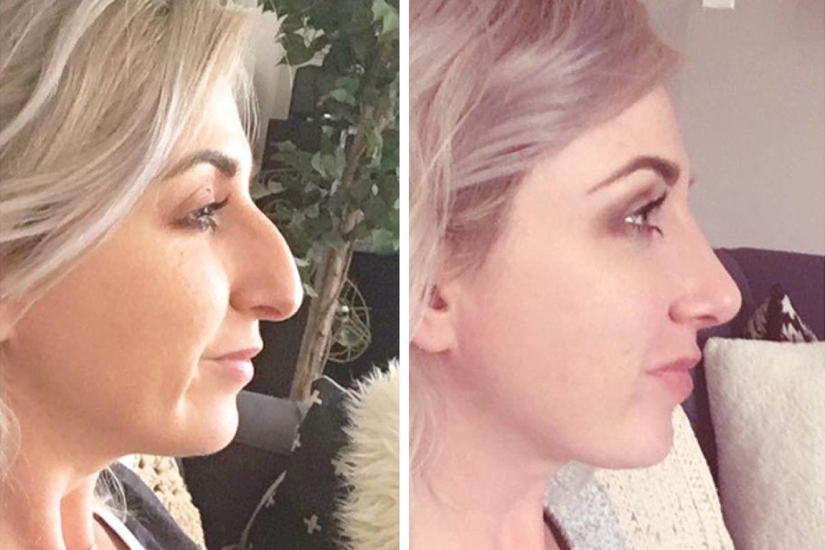 Sssniperwolf Nose Job