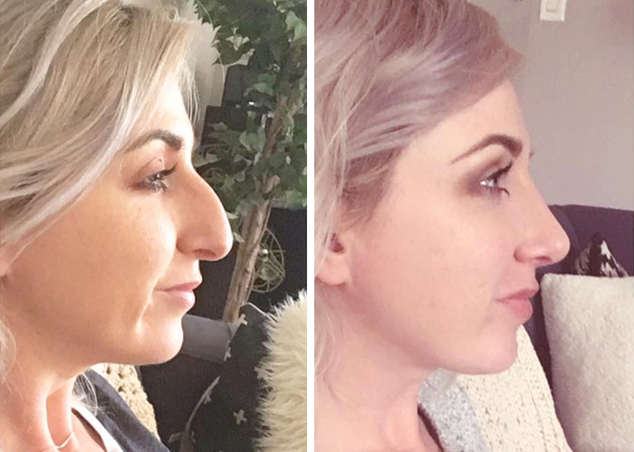 Nose Before and After